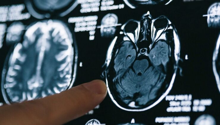 Alzheimer hastaları için gerçek bir tedavi sunan ilk ilaç: Lecanemab nedir? Lecanemab’ın yan etkileri nelerdir?